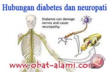 Perdossi: neuropati sering tidak disadari sebagai penyakit 