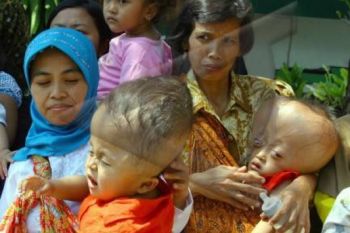 Jateng Kaji Penderita Hidrocephalus Dijamin BPJS