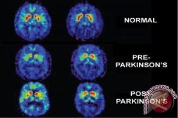 Laki-Laki, Bukan Perempuan, Yang Sering Terkena Parkinson
