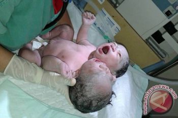 Bayi berkepala dua lahir di Makassar 