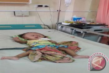 Amanda penderita hydrocephalus dijadwalkan dioperasi