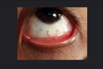 Mata rabun usir lewat lasik