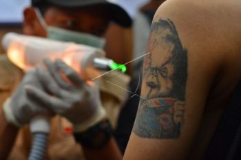 Program pelayanan hapus tato gratis