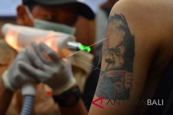 Layanan Hapus Tato Gratis