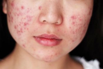 Benarkah "facial" ampuh atasi kulit berjerawat?, ini jawabannya