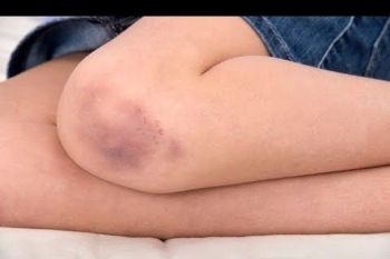 Ini tips perawatan agar luka memar cepat sembuh