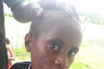 Dinkes Papua temukan frambusia-filariasis di Asmat dan Yahukimo