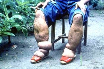 Memberantas kaki gajah