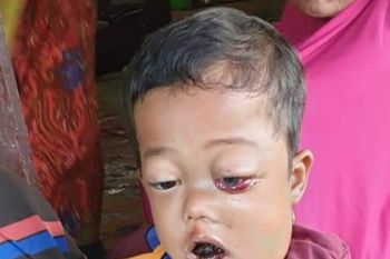 Bocah 2 tahun menderita kanker rahang butuh bantuan