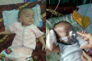 Balita bocor jantung asal Sumbawa membutuhkan bantuan