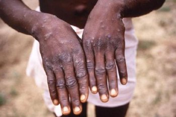 Before coronavirus, the world once fought off smallpox