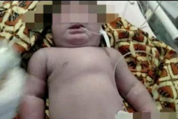 Bayi bermata satu di Siak meninggal dunia