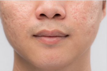 Cara efektif atasi bekas jerawat menurut dokter
