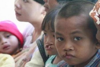 Puluhan warga bibir sumbing   Ogan Komering Ulu dioperasi gratis
