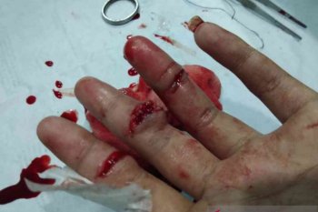 Kawanan begal di Bekasi membacok tangan Fazrin hingga nyaris putus