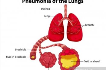 Penderita pneumonia berat  di Wuhan meninggal
