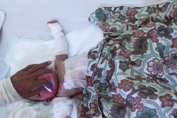 Memilukan, bayi 10 bulan di Inhil alami luka bakar parah