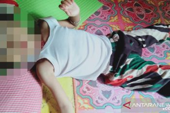 Seorang balita di Dharmasraya diduga menderita gizi buruk