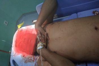 Pejambret HP di Loteng masuk rumah sakit setelah nekat tabrak mobil polisi