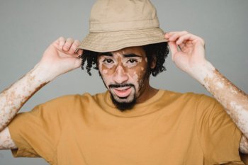 Dokter : Pasien vitiligo boleh vaksin COVID-19 dengan syarat