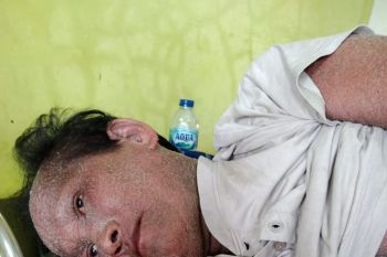 Pemkab Pessel pastikan tidak ada kompensasi bagi korban dampak vaksin