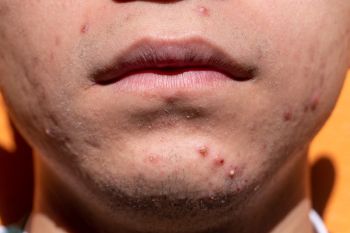 Dokter izinkan pakai "skincare" jika masalah  jerawat sudah teratasi