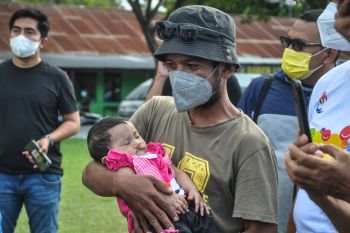 Ini penyebab bibir sumbing dan pencegahannya