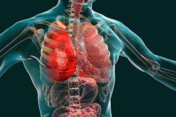 Pneumonia bisa dicegah dengan perbaiki gizi dan imunisasi