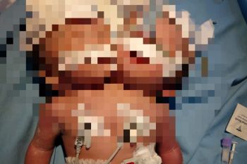 Bayi kembar siam dua kepala satu badan dirujuk ke RSUP dr M Djamil Padang