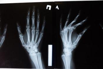 "Menabung tulang" sejak dini mencegah osteoporosis