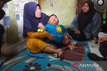 Balita 16 bulan di Bekasi berbobot 27 kilogram, ini faktanya