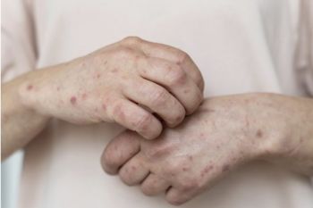 Govt responds to Australia's measles notice from RI travel history