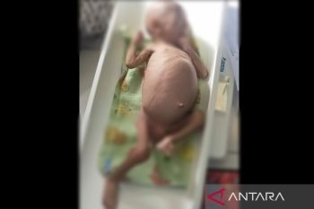 Dinkes tangani bayi di Kota Karawang alami gizi buruk