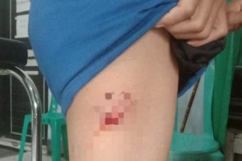 Tiga anak di Dompu digigit anjing rabies dari di bokong sampai wajah