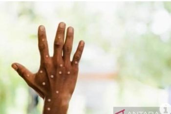 Waspadai Cacar Monyet, meski tak lagi berstatus darurat global