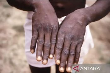 Monkeypox: Port Health Office tightens supervision at Soetta Airport