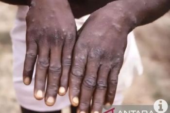 Mpox: Jakarta continues close contact tracing to fight transmission