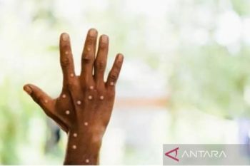 Jakarta monkeypox cases mostly HIV positive: Official