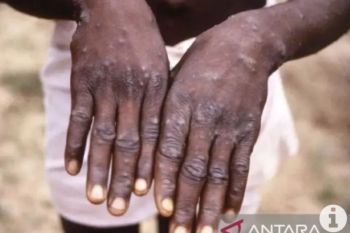 All 24 monkeypox patients are mildly symptomatic males: Official