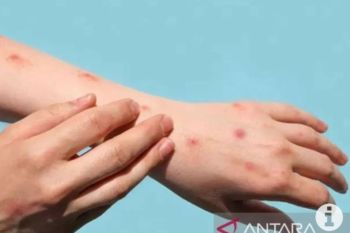 Positive mpox cases reach 29: Official