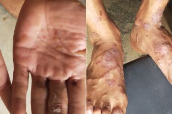 Dinkes Batam perkirakan lebih satu kasus cacar monyet di Batam