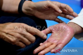 Dokter ungkap autoimun bukanlah penyakit menular