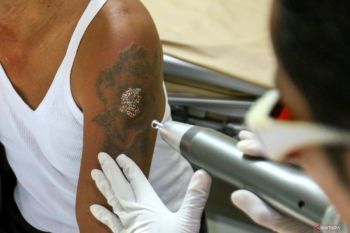 Layanan hapus tato gratis