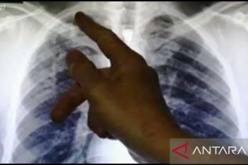 Perokok aktif di atas 40 tahun perlu skrinin kanker paru, kata dokter