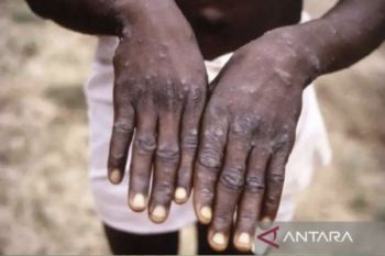 Cacar Air cuma sekali seumur hidup? Ini fakta di balik infeksi Varicella-zoster