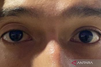 Mengenal Ptosis, kondisi mata telihat "ngantuk" menurut medis&nbsp;
