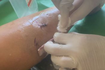 Tanjungpinang Kepri tangani lansia digigit anjing liar