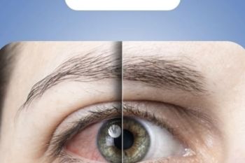 Teknologi SiLK hadir sebagai tindakan lasik mata tanpa flap