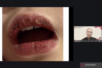 Waspadai gejala kawasaki pada anak yang sering salah diagnosis