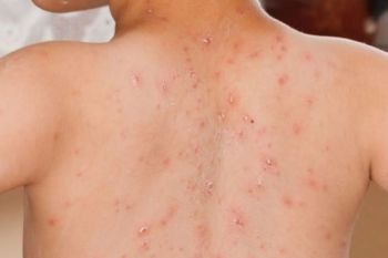 Tercatat sudah ada 1.303 kasus suspek campak di Riau sejak Januari hingga Maret 2026